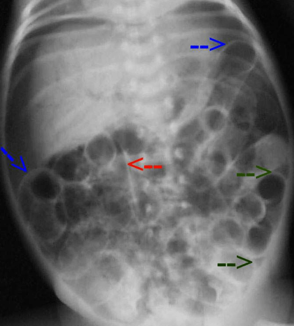Necrotizing enterocolitis — Medlibes Online Medical Library